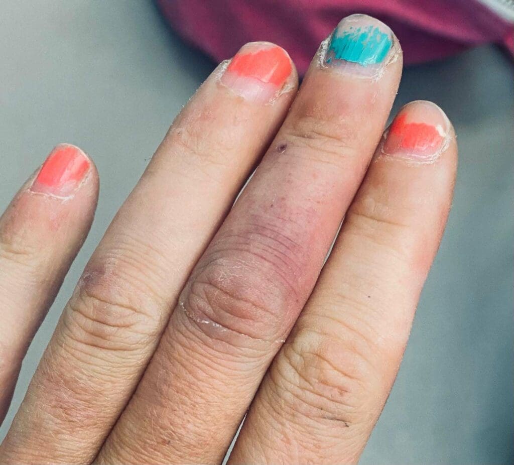 Climbing Injury Recovery: How To Stay Strong And Motivated